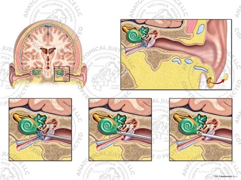 Surgical Repair of Left Perilymphatic Fistulas - No Text