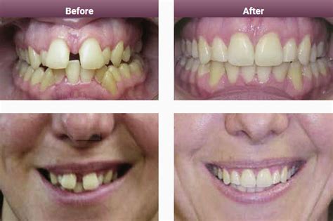 Invisalign Results & Case Studies Melbourne | Smile Solutions