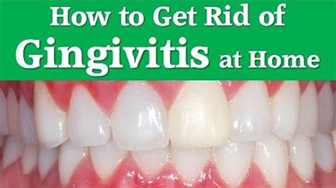 Gingivitis Causes at Lee Fitzgerald blog