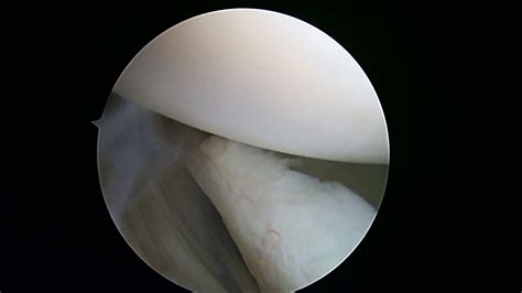 R shoulder arthroscopic debridement 1 16 23 JT - YouTube