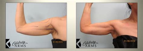 Arm Liposuction Before and After Results Small