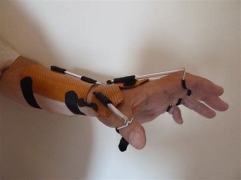 Splint in the Spotlight – Radial Paralysis: a progressive orthosis ...