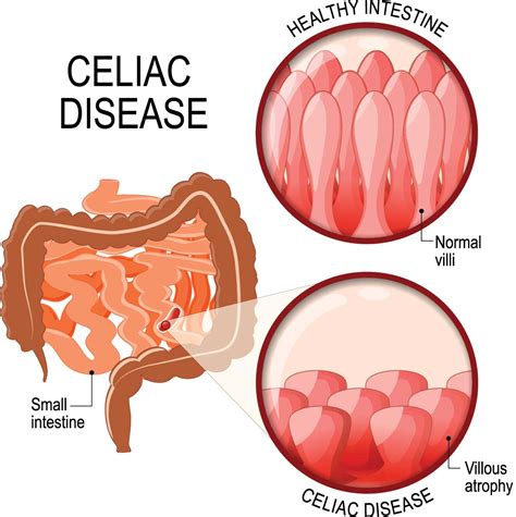 Celiac Disease - Northern Virginia Gastroenterology