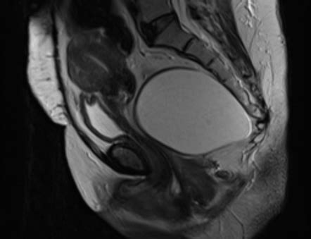 Tailgut duplication cyst | Radiology Case | Radiopaedia.org