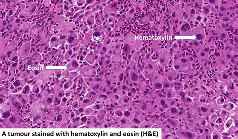 Hematoxyline en eosine (H&E) | MyPathologyReport.ca