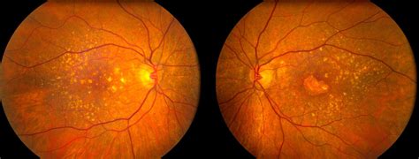 AMD patients unaware of new lenses - Optician