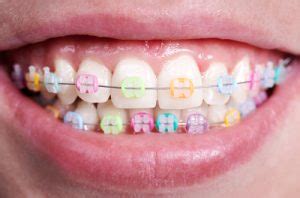 What Your Braces Colors Say About Your Personality - Soleil Orthodontics