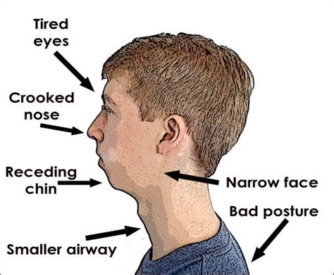 Mouth Breathing and Blocked Nose | ENT Specialist Singapore