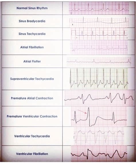 Ekg Practice Strips Printable