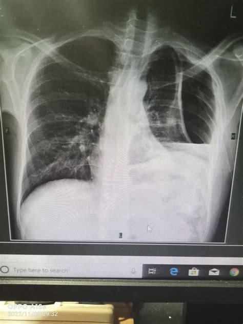 Hydropneumothorax – Radiobyan