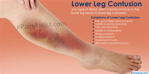 Lower Leg Contusion|Symptoms|Treatment|Stretching, Strengthening ...