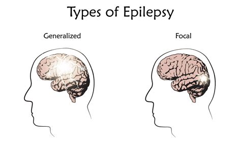 Epilepsy Types