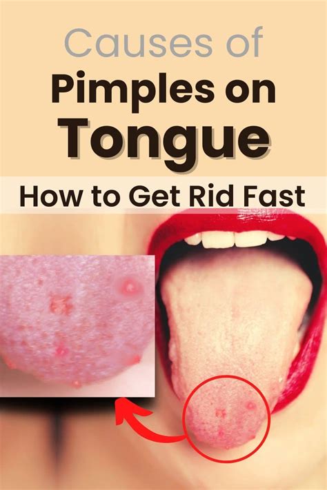 Pimples on Tongue? Lie Bumps Tongue, Causes, Get Rid of it - MG