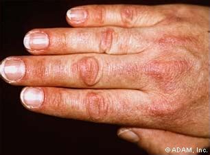 The New York Times > Health > Image > Dermatomyositis, Gottron's Papule