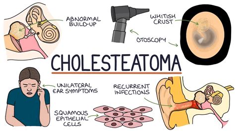 Cholesteatoma