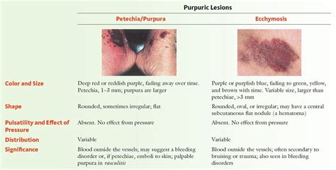 Ecchymosis Vs Bruise