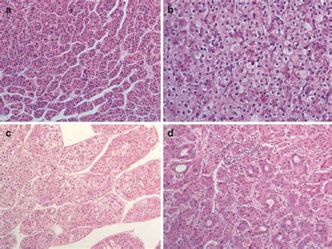 4 Main histological pattern of hepatocellular carcinoma: (a ...