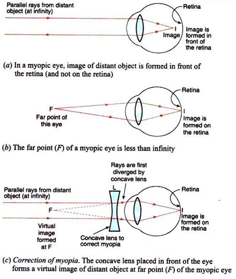 Explain with the help of labelled ray diagram, the defect of vision ...