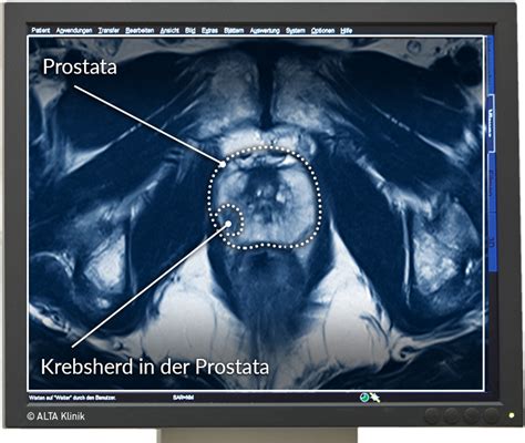 Sichere Prostatavorsorge mittels MRT-Untersuchung der Prostata