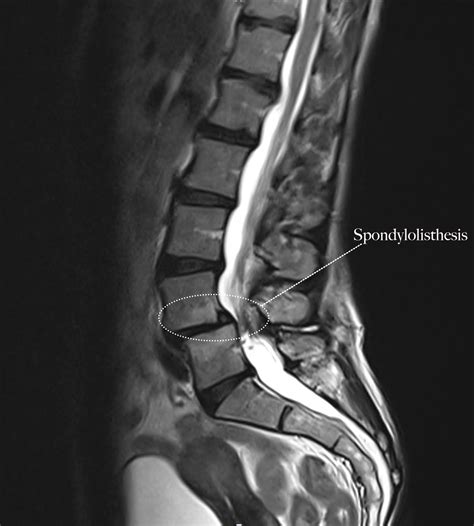 Spondylolisthesis Treatment | Bonati Spine Institute