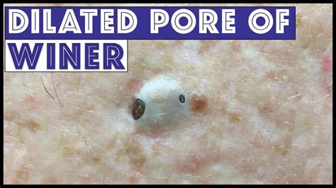 Dilated Pore of Winer Giant Blackhead Satisfying Extractio ...