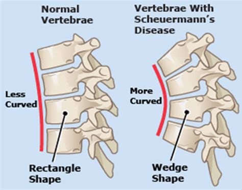 Scheuermann’s disease Symptoms and Treatment | Mediologiest