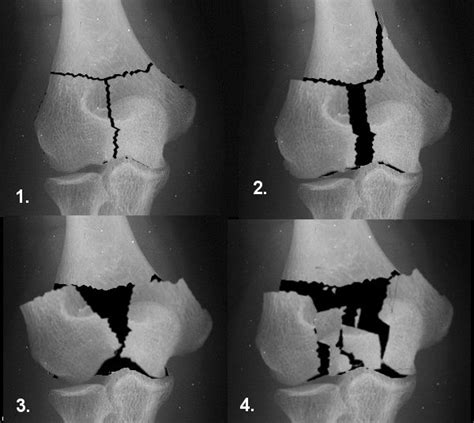 Distal Humeral fractures