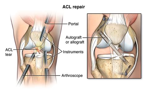 Knee Ligament Repair | Johns Hopkins Medicine