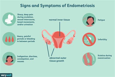 Endometriosis Pain Location - 11 Natural Treatments For Endometriosis ...