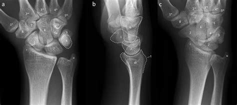 Normal Wrist X Ray Lateral