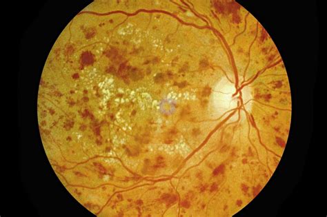 Understand the Four Stages of Diabetic Retinopathy