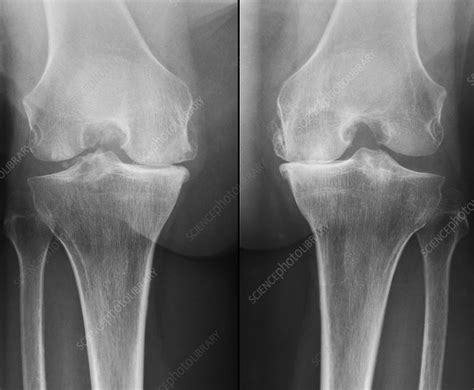 Knees in osteoarthritis, X-ray - Stock Image - C051/7950 - Science ...