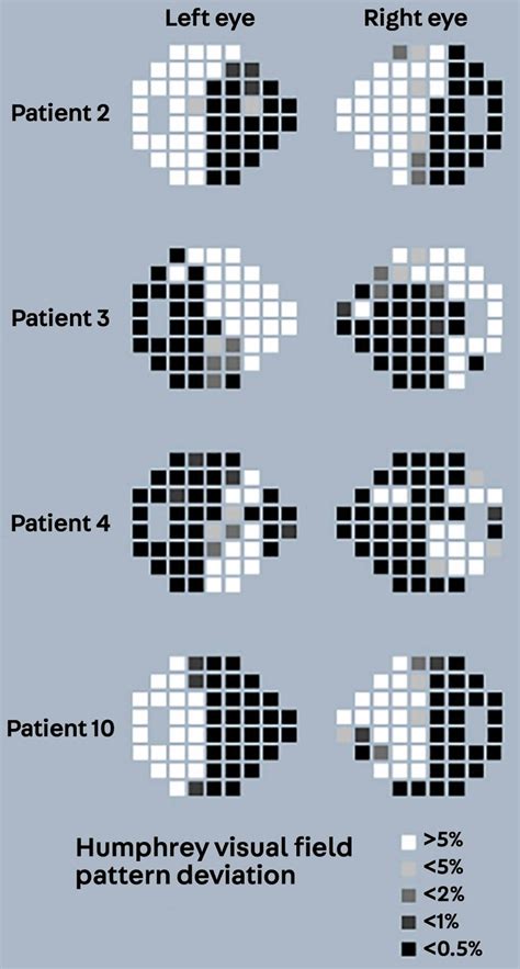 Posterior cortical atrophy causes, symptoms, diagnosis, treatment ...