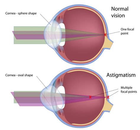 What Is Astigmatism? Causes, Symptoms & Treatment