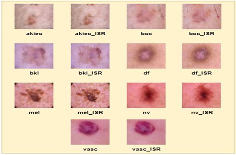 Applied Sciences | Free Full-Text | Skin Cancer Classification ...