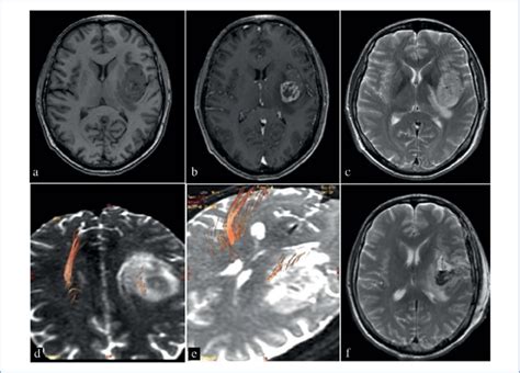 MRI of patient V. with tumor of the left insular lobe. a — Т1 prior to ...