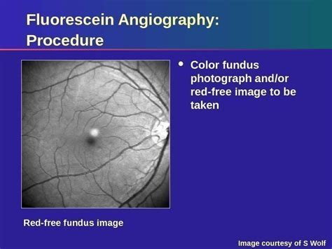 Identifying Choroidal Neovascularization Using Fluorescein Angiography ...