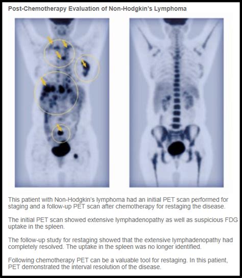 Lymphoma Stage 4 Cancer Pet Scan : Current Status Of Pet Ct In The ...