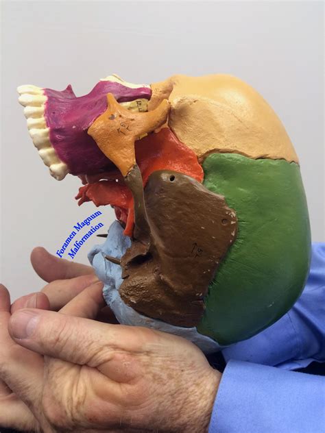 "The most powerful cranial adjustment"... CV-4, or "occipital bulb ...