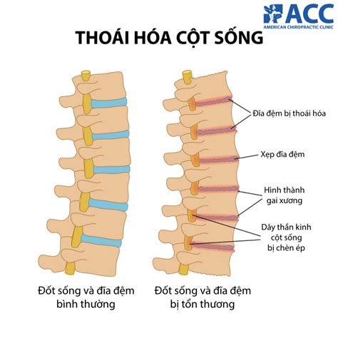 Thoái hóa cột sống là gì? Nguyên nhân, triệu chứng và cách điều trị | ACC