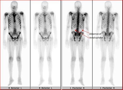 Widespread metastatic bone cancer – A “Super Scan” | Nuclear Medicine ...