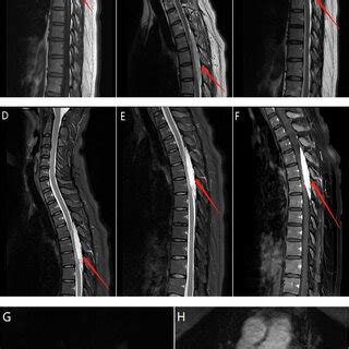 -(A) T1-weighted sagittal magnetic resonance imaging (MRI) of the ...