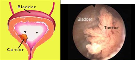 Bladder Cancer | Chin Chong Min Urology & Robotic Surgery Centre