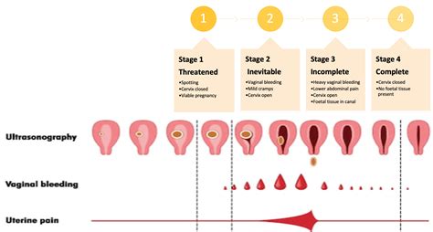 Recurrent Miscarriages - Enhanced Fertility