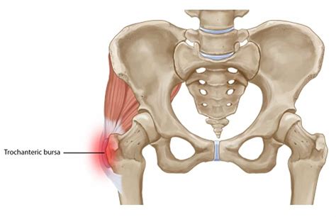 Trochanteric Bursitis - Running Tips for Chubby People | The Chubby Runner