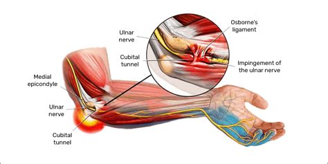 Ulnar Nerve Entrapment (Cubital Tunnel Syndrome) | USASC & Orthopedics