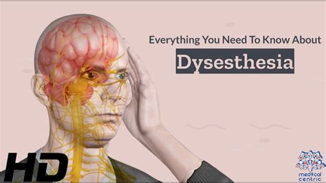 Dysesthesia 101: A Comprehensive Guide to this Mysterious Condition ...