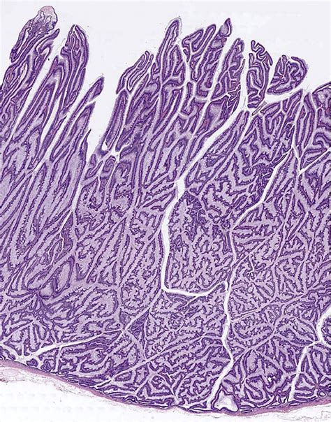 Pathology Outlines - Tubulovillous / villous adenoma