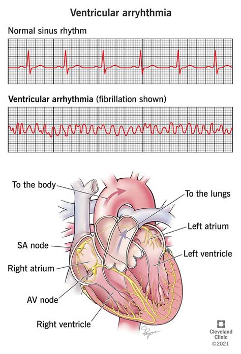 Heart Arrhythmia Symptoms