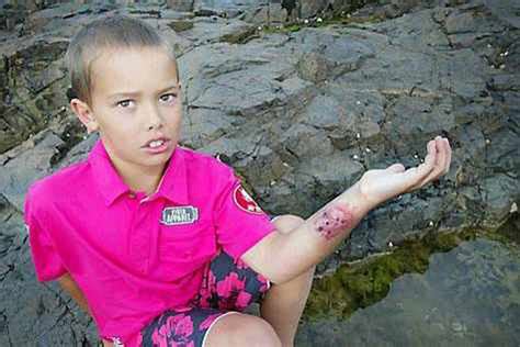 Parents warned after sea anemone stings youngster | Guernsey Press